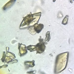 Cristales de ácido úrico