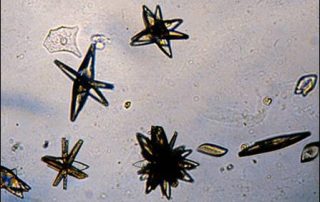 Cristales de ácido úrico